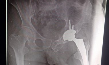 आयुष्मान भारत के तहत द्वारिका अस्पताल में टूटे कूल्हे का सफल ऑपरेशन किया गया