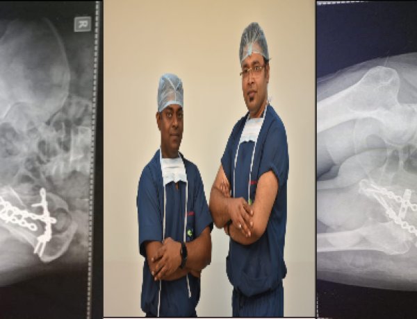 कूल्हे एवं पेल्विस बोंस की दोनों टूटी हड्डियों को पारस के चिकित्सकों ने सर्जरी कर ठीक किया